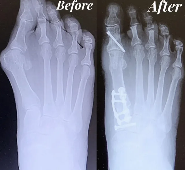 Before and after X-rays of a bunion correction, the realigned bones held with surgical screws