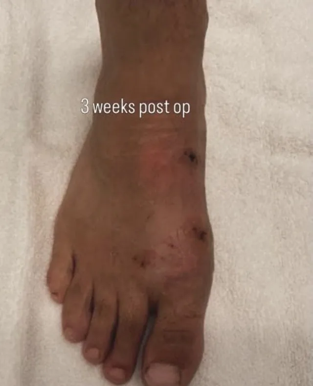 The same foot three weeks after minimally invasive bunion surgery, with small healed incision marks