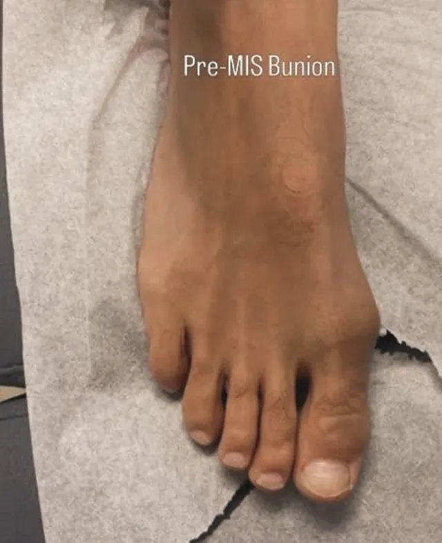 A foot photographed before minimally invasive bunion surgery, showing the bump at the base of the big toe