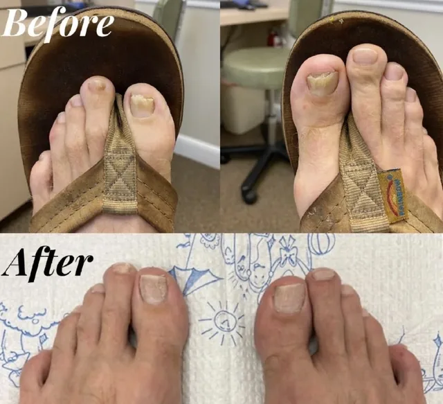 Before and after photographs of toenail treatment, showing clearer nail growing in