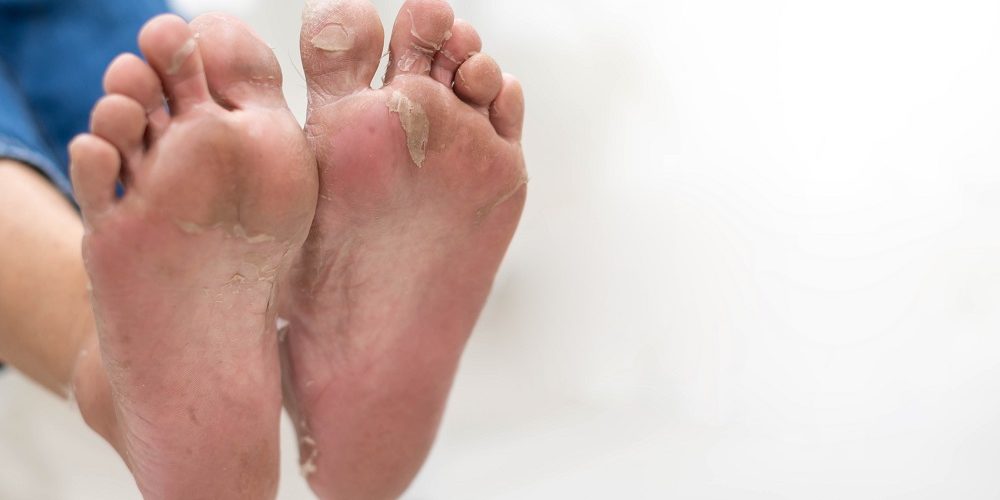 Preventing Complications: A Guide to Diabetic Foot Care