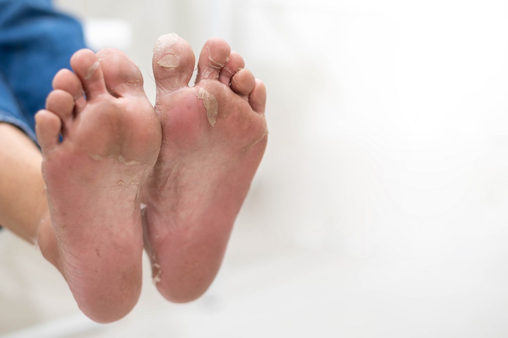 Preventing Complications: A Guide to Diabetic Foot Care