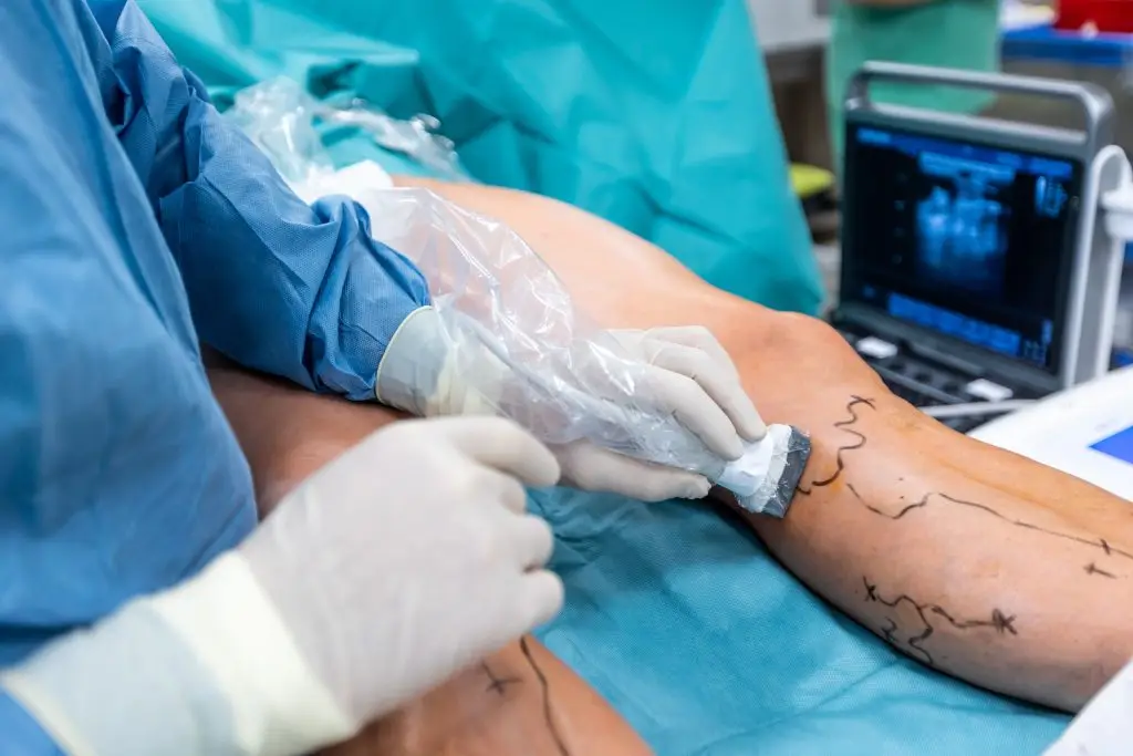 Spider Vein Treatment in Jupiter
