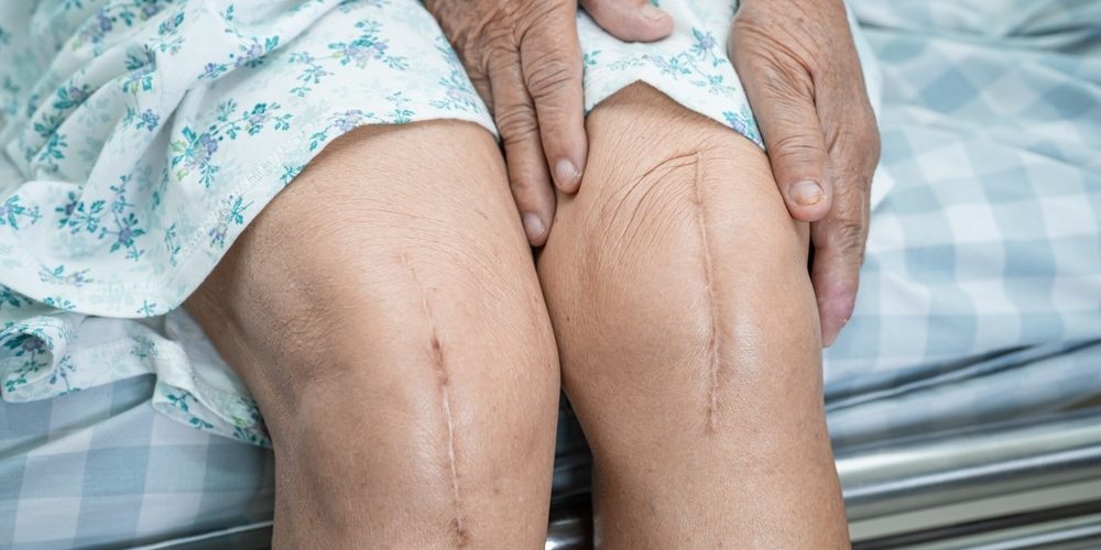 Care Of Surgical Wounds At Home To Prevent Infection Care Of Surgical Wounds At Home To Prevent Infection