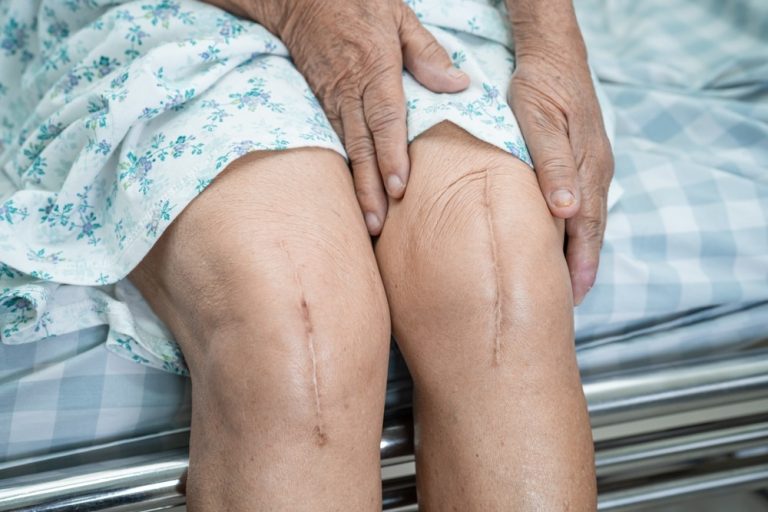 Care Of Surgical Wounds At Home To Prevent Infection