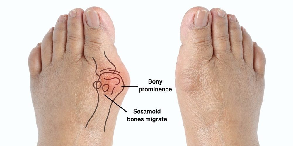 Types of Bunion Surgery Types of Bunion Surgery
