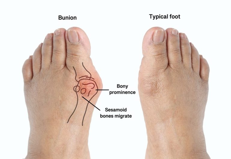 Types of Bunion Surgery