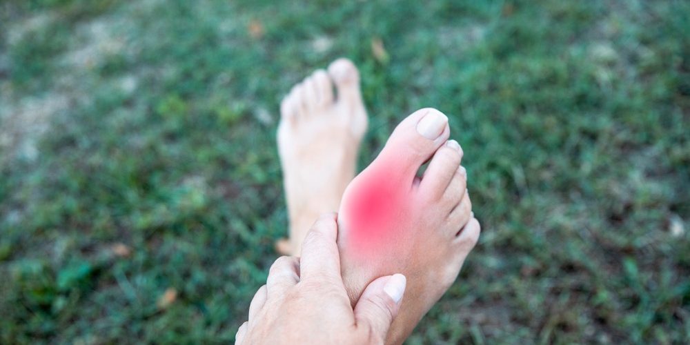 Understanding Bunions