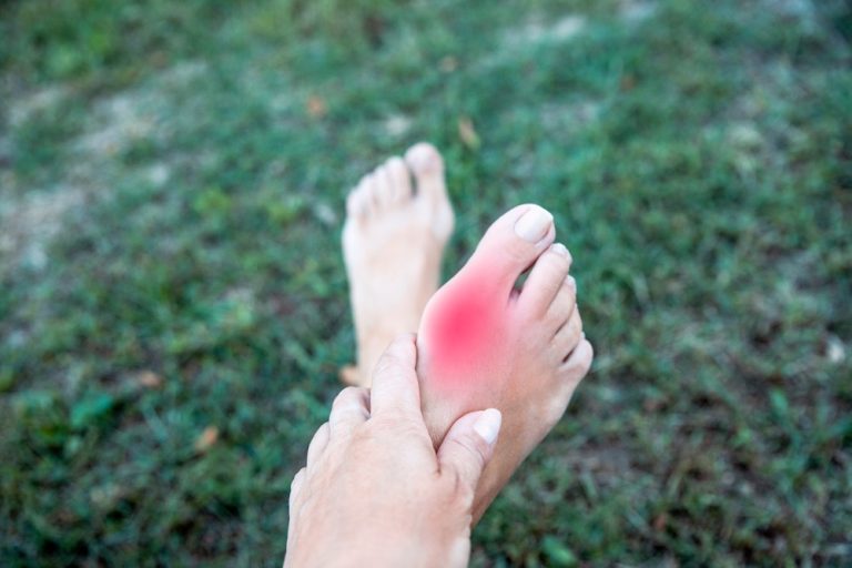 Understanding Bunions
