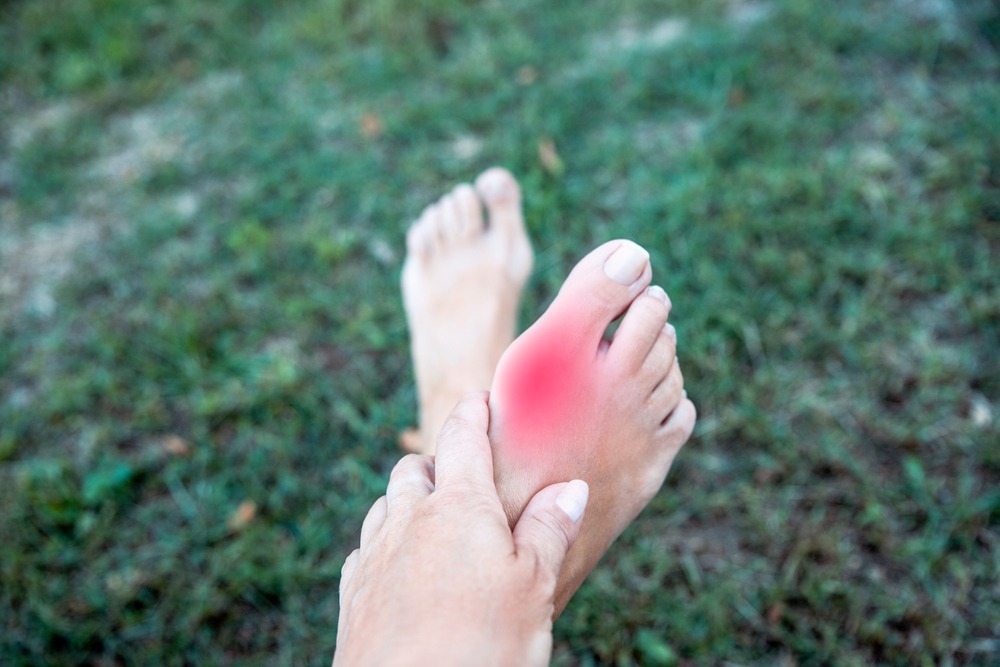 Understanding Bunions: Causes, Symptoms & Effective Treatments