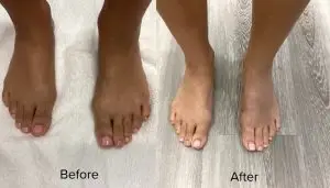 Bunionplasty Before And After