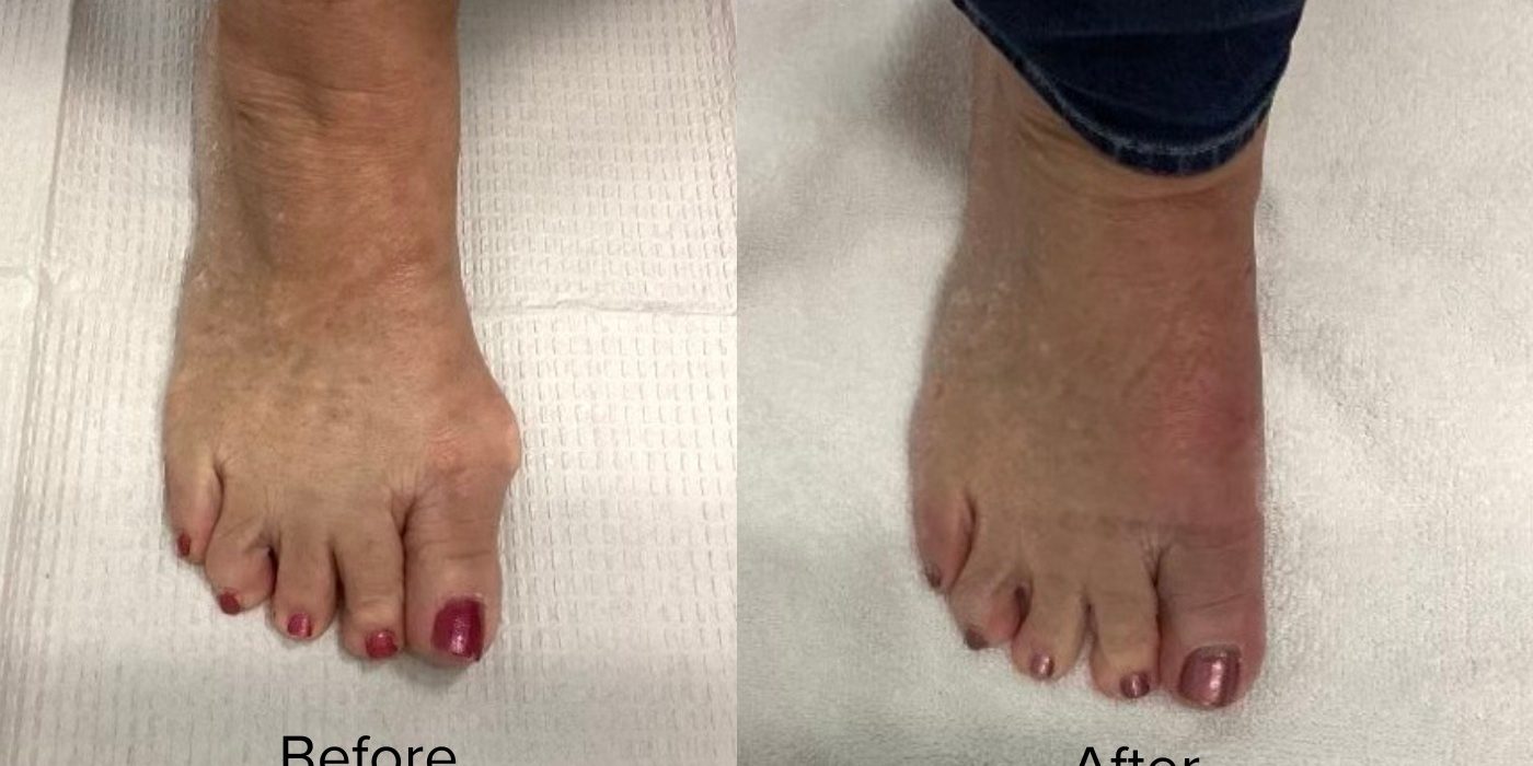 Bunion plasty Procedure Before and after