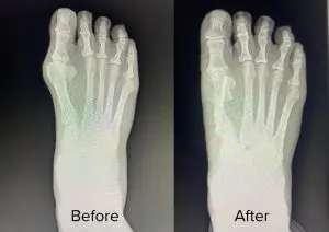 Bunion Surgery Before And After