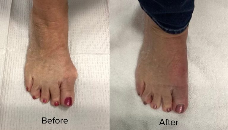 Bunion plasty Procedure Before and after