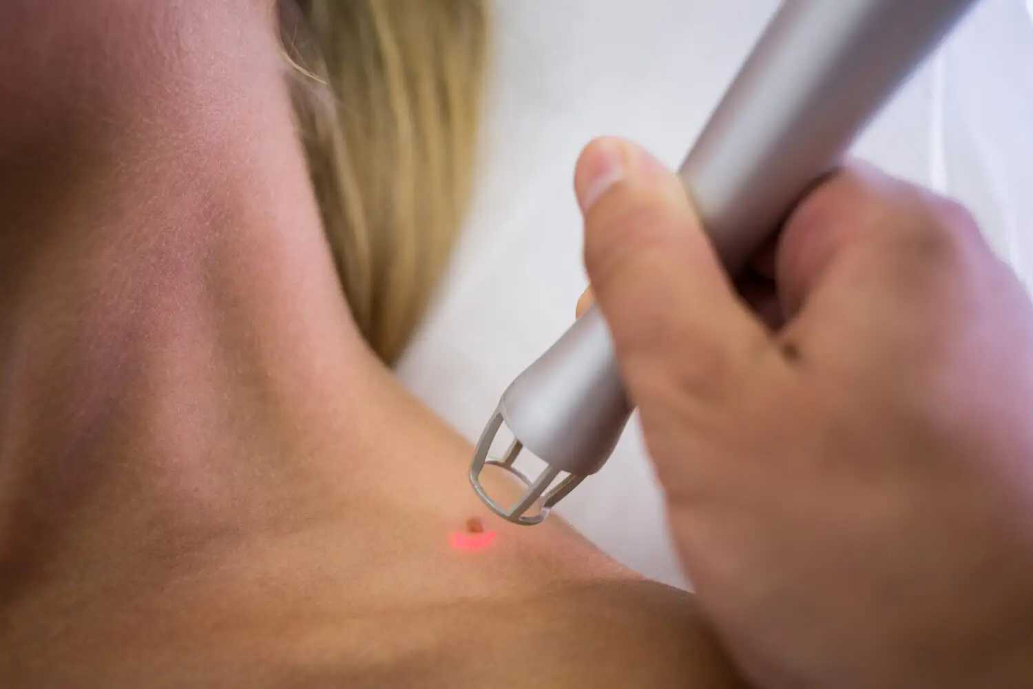 What Types of Wounds and Scars Can Benefit from Laser Therapy