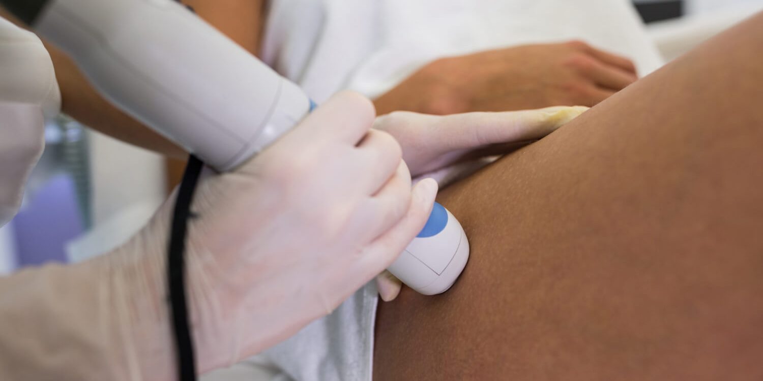 What to Expect with Sclerotherapy Before and After Insights What to Expect with Sclerotherapy Before and After Insights