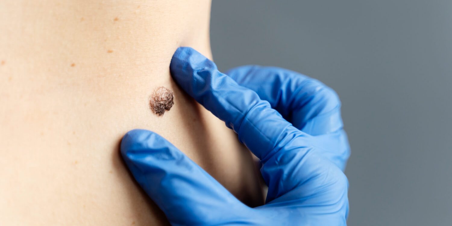 Why Warts Keep Coming Back Effective Laser Treatments for Lasting Results Why Warts Keep Coming Back Effective Laser Treatments for Lasting Results