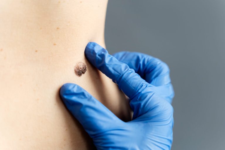 Why Warts Keep Coming Back Effective Laser Treatments for Lasting Results