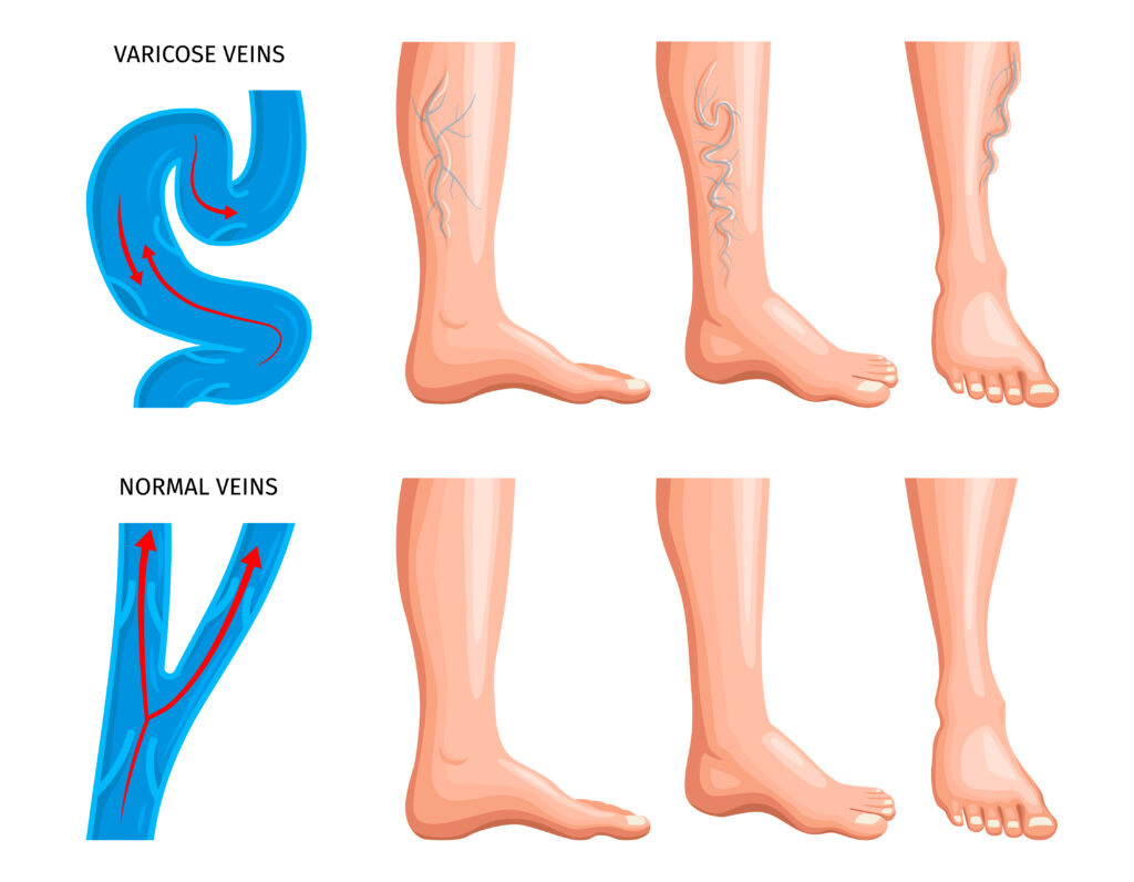 Spider veins vs.
varicose veins difference